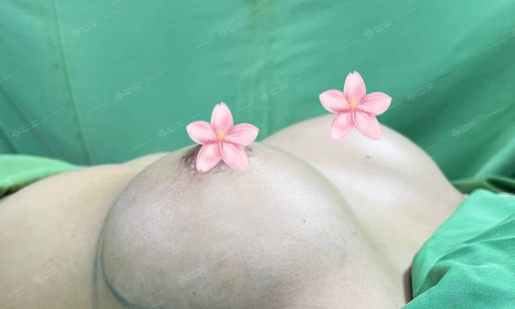 Góc giải đáp: Nâng ngực mất bao nhiêu thời gian