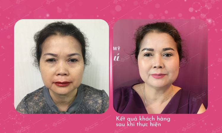 Phẫu thuật nâng cung mày bao lâu thì làm lại được?