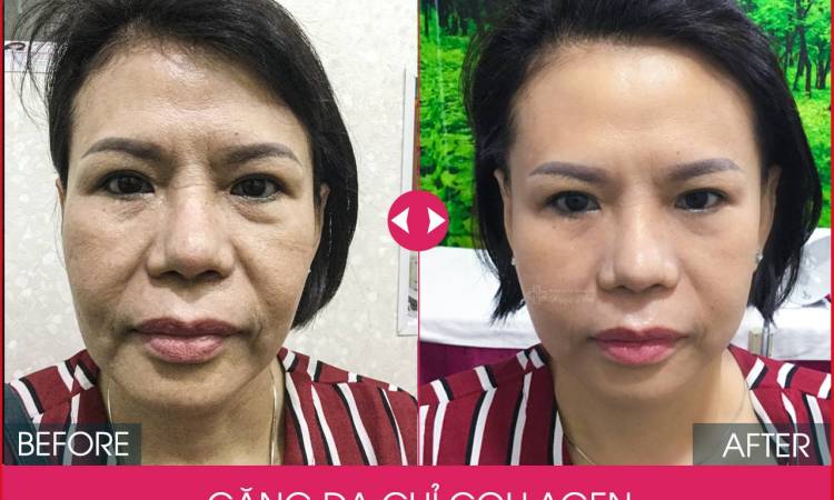 Những tác hại của phương pháp căng chỉ collagen
