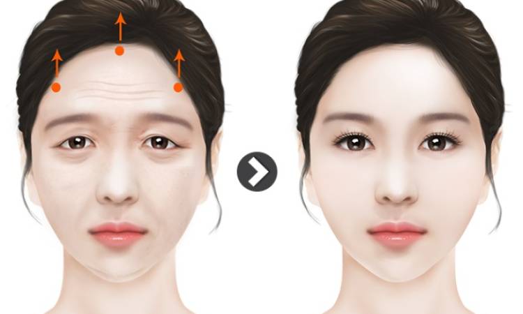Nâng cung mày kiêng ăn bao lâu? Top những thực phẩm nên tránh xa