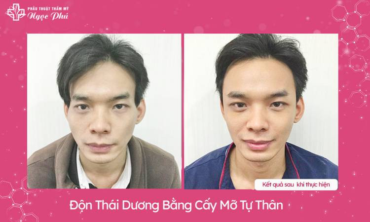 Độn thái dương bằng cấy mỡ tự thân