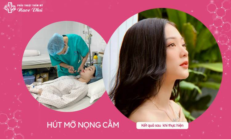Hút mỡ nọng cằm