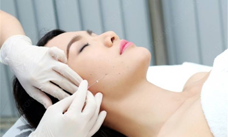 Căng da mặt bằng chỉ collagen
