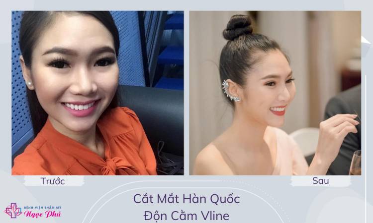 Nâng mũi cấu trúc ở đâu đẹp ?