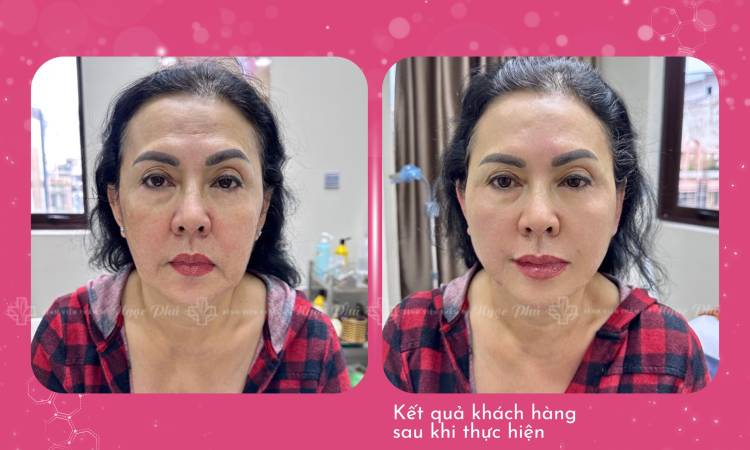 Tư Vấn Căng Da Mặt Chỉ Collagen 4D