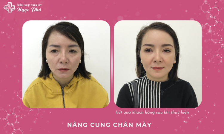 Nâng Cung Chân Mày