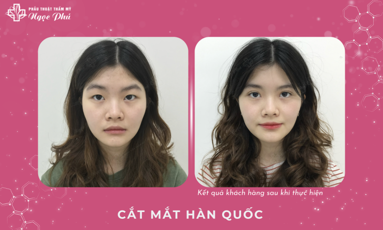 Cắt Mắt Hàn Quốc