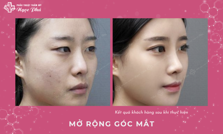 Mở Rộng Góc Mắt