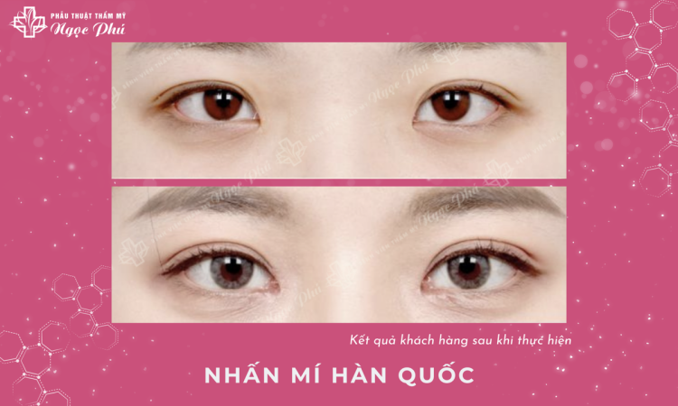Nhấn mí Hàn Quốc