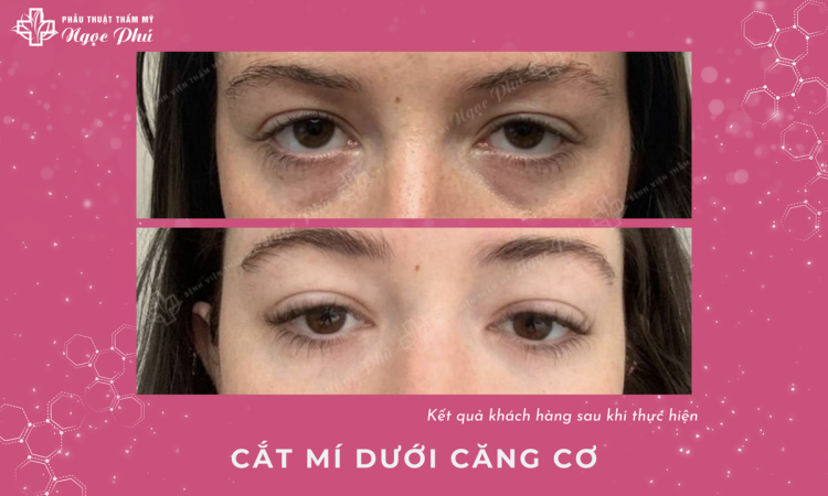 Cắt Mắt Mí Dưới