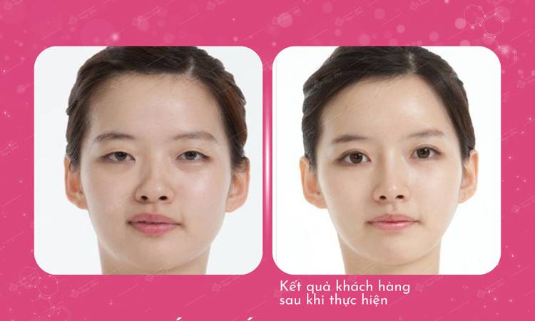 Cắt Mắt Bambi