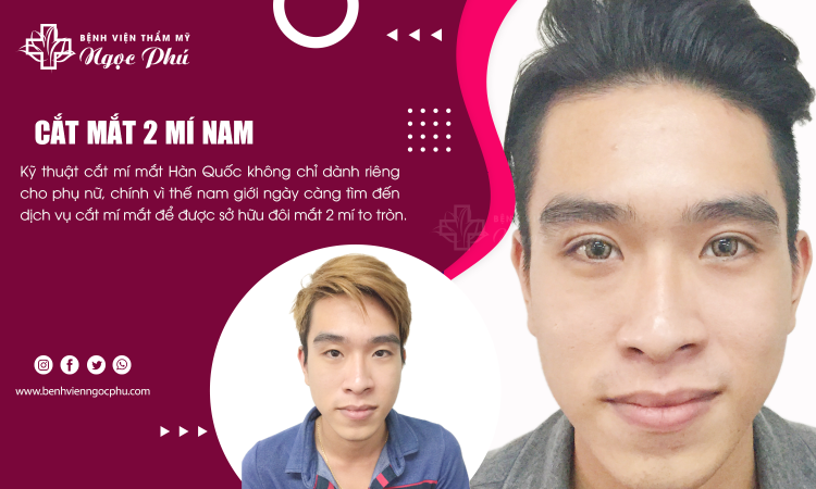 Cắt Mắt 2 Mí