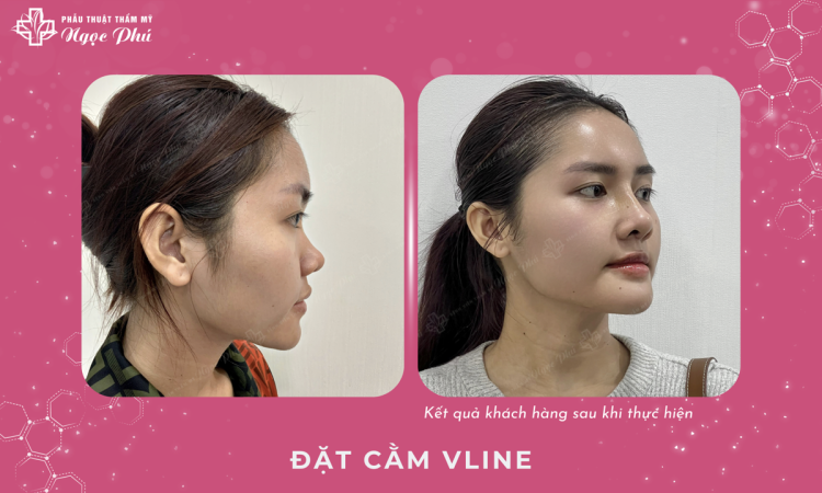 Đặt Cằm V-line