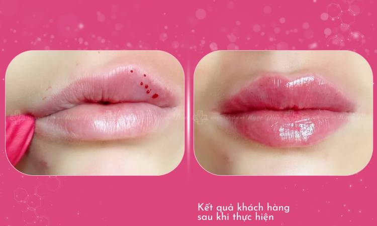 Tiêm Filler Tạo Hình Môi