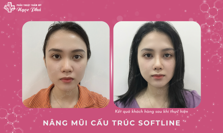 Nâng mũi cấu trúc Soft Line