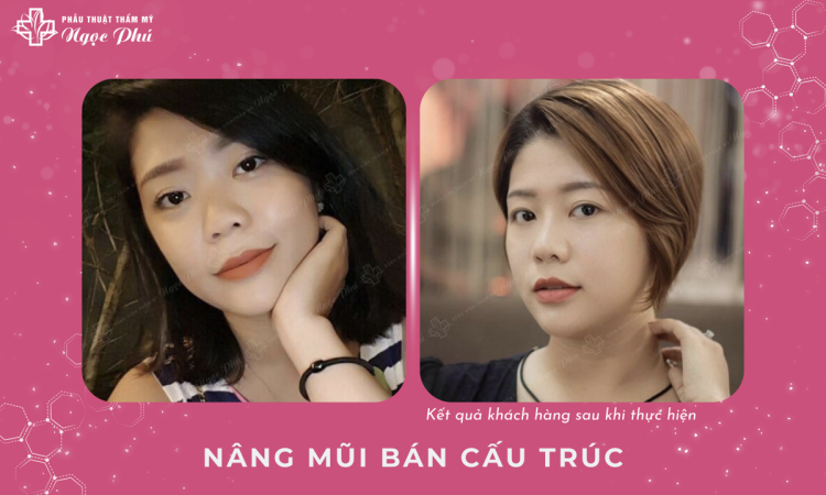 Nâng mũi bán cấu trúc Soft Line
