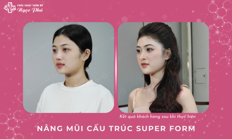 Nâng mũi Super Form