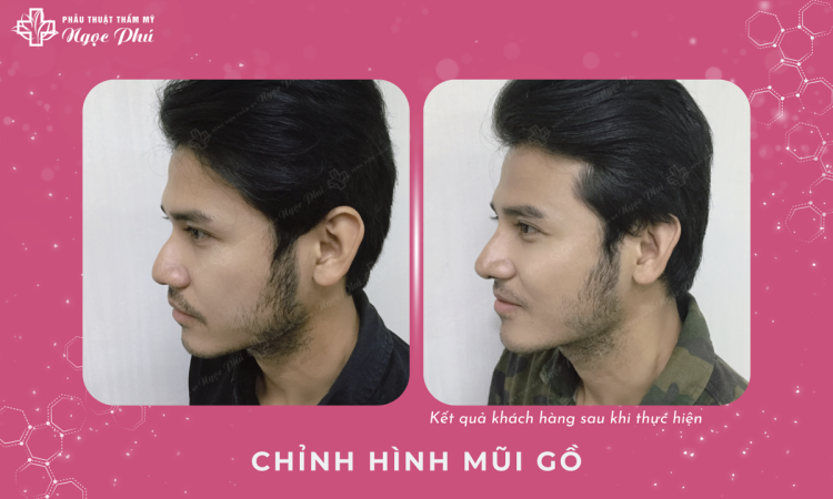 Chỉnh Hình Mũi Gồ