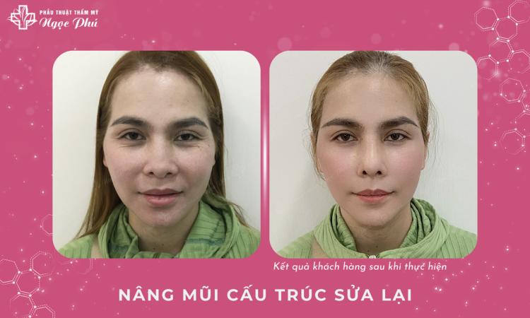Nâng mũi cấu trúc Sửa Lại