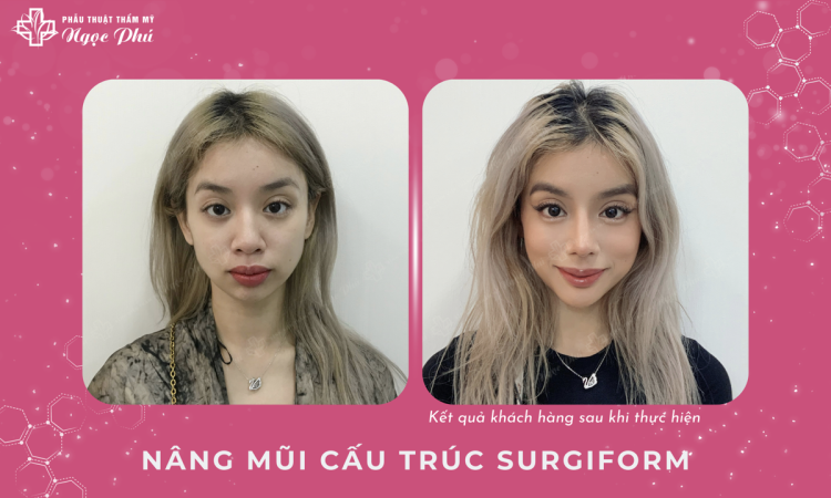 Nâng Mũi Cấu Trúc Surgiform
