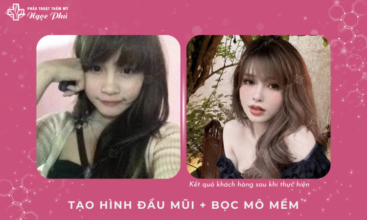 Tạo Hình Đầu Mũi