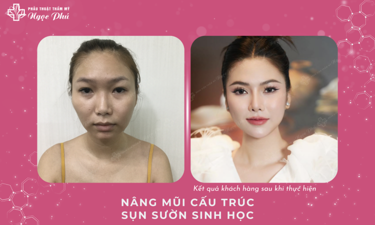 Nâng Mũi Cấu Trúc Sụn Sườn Sinh Học
