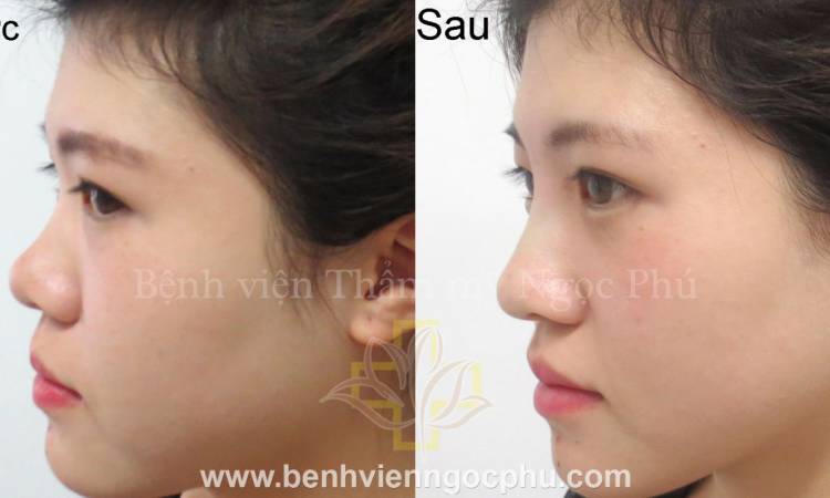 NÂNG MŨI S LINE HÀN QUỐC AN TOÀN DÀNH CHO PHÁI ĐẸP !