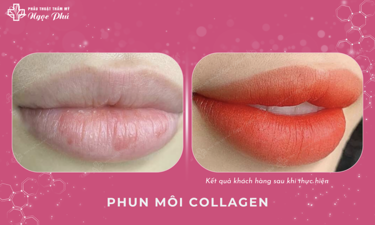 Phun Môi Collagen