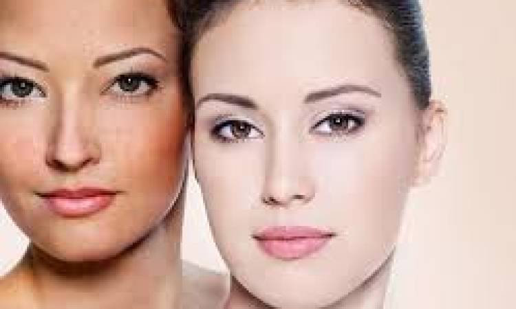 Melasma Treatment With Elight Laser Light