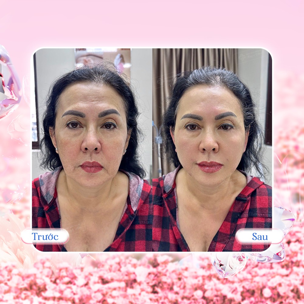Căng da mặt là phương pháp thẩm mỹ được nhiều người ưa chuộng để trẻ hóa da, xóa mờ nếp nhăn và lấy lại vẻ ngoài tươi trẻ.