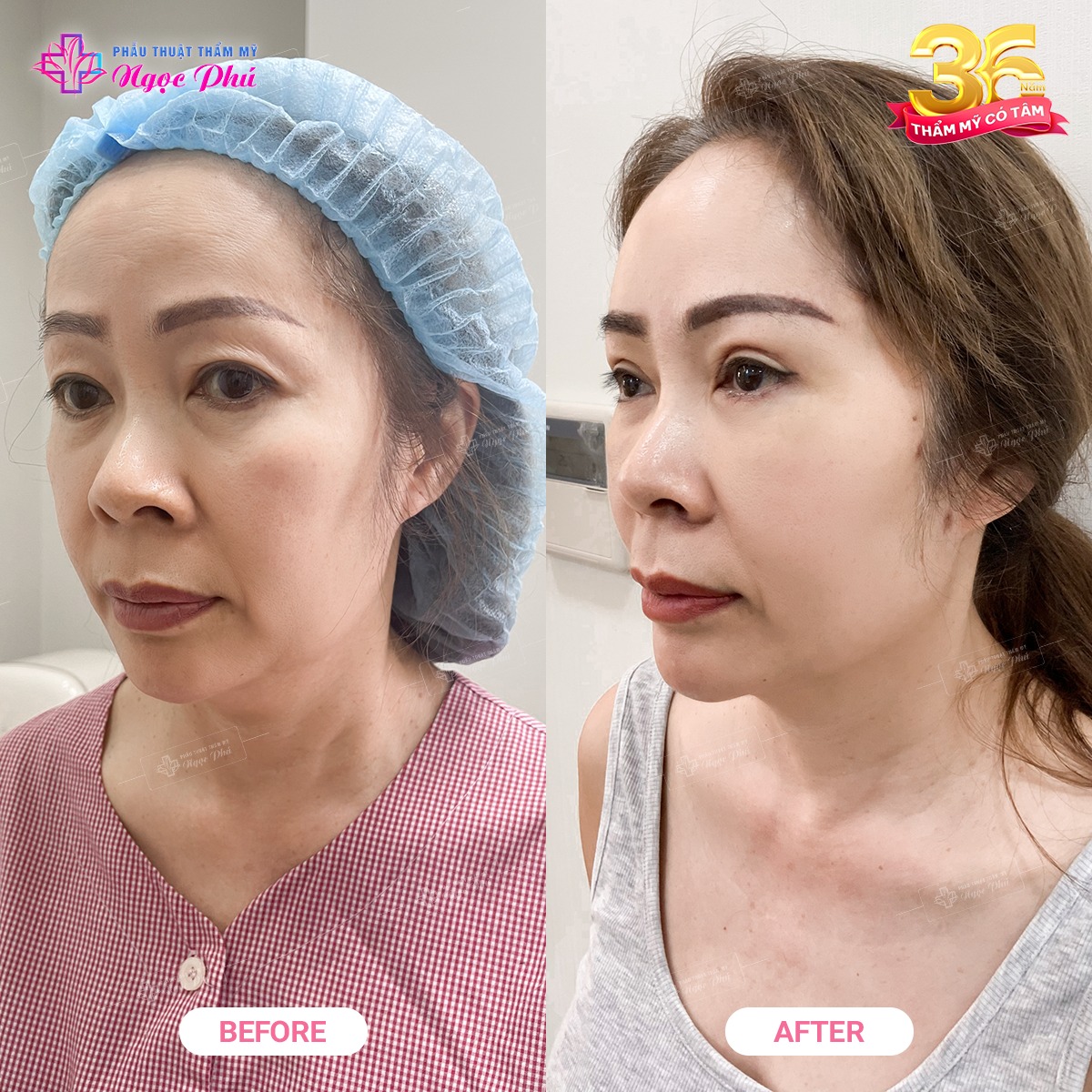 biến chứng căng da mặt
