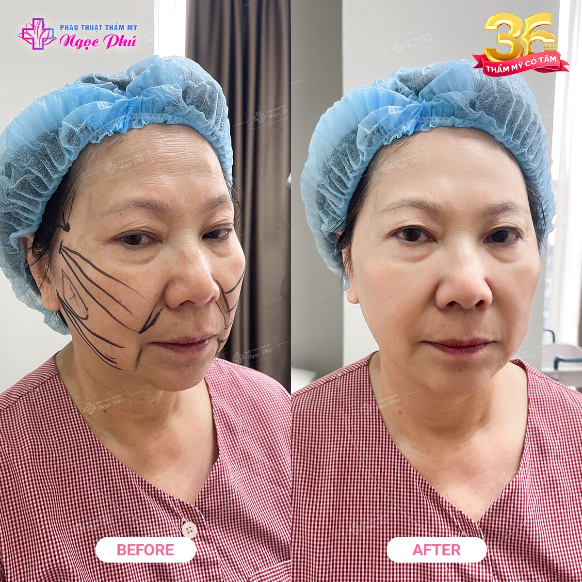 Căng da mặt bằng chỉ collagen