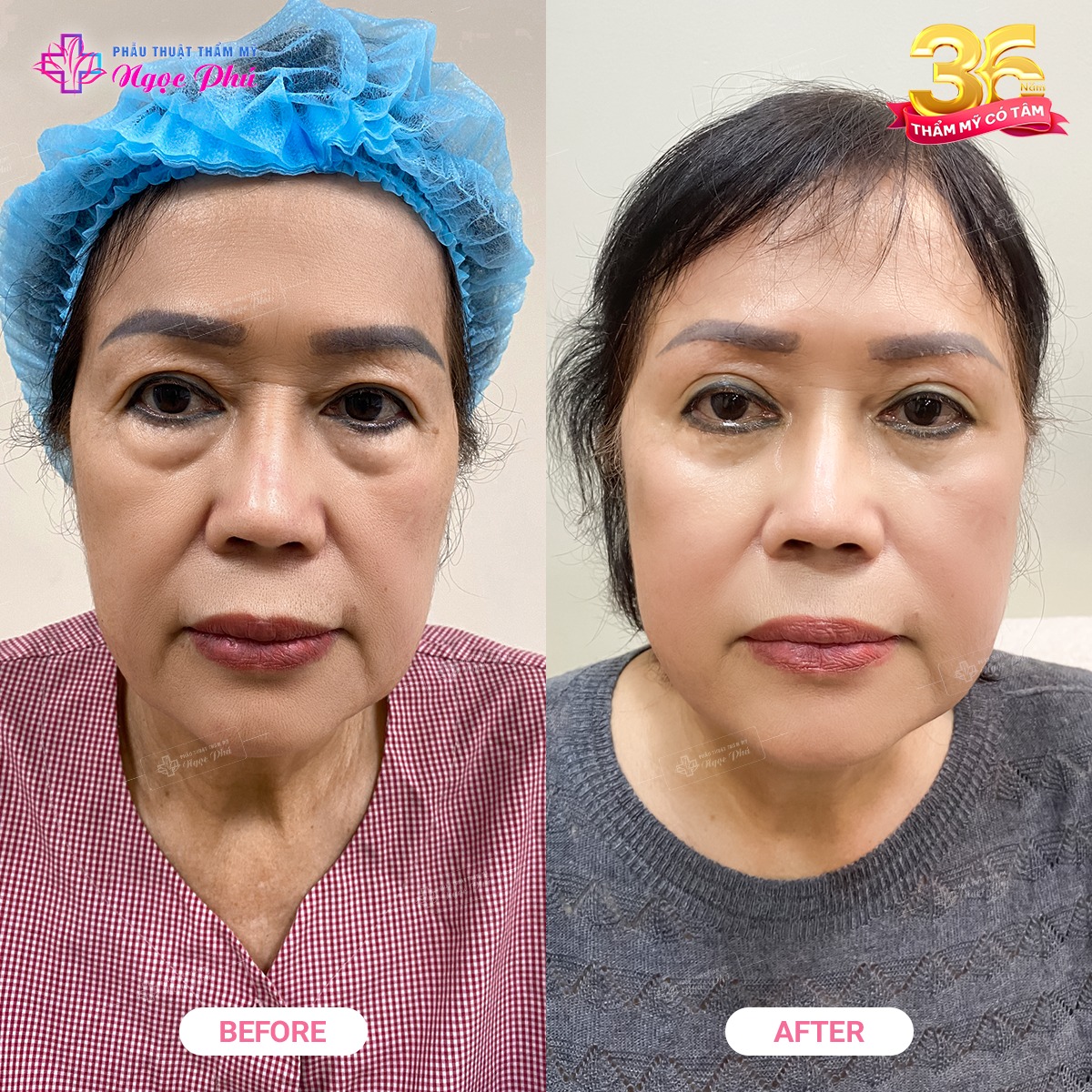 Phẫu thuật căng da mặt