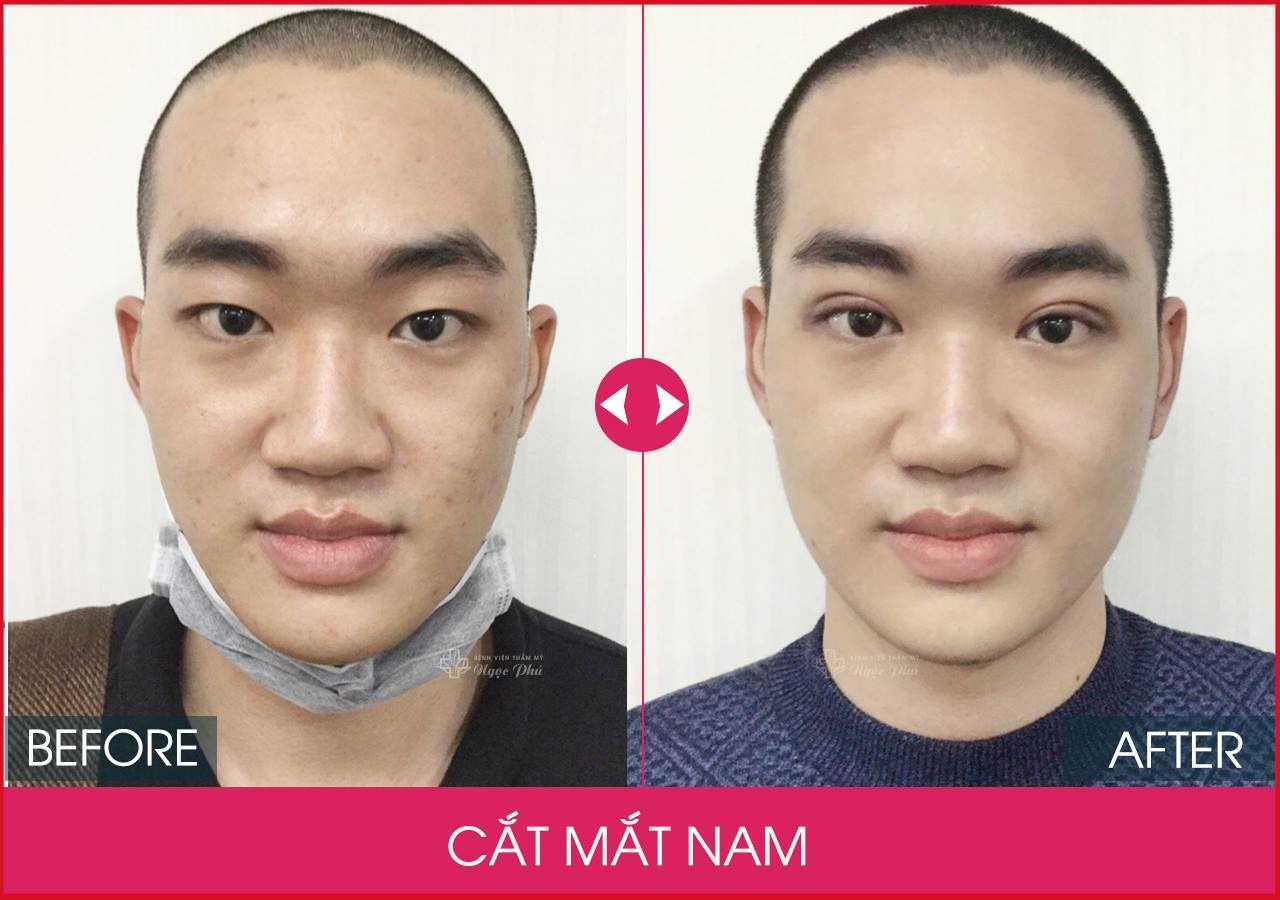 Cắt mắt 2 mí nam giới được thực hiện bởi bác sĩ tại Ngọc Phú, thể hiện được vẻ đẹp nam tính