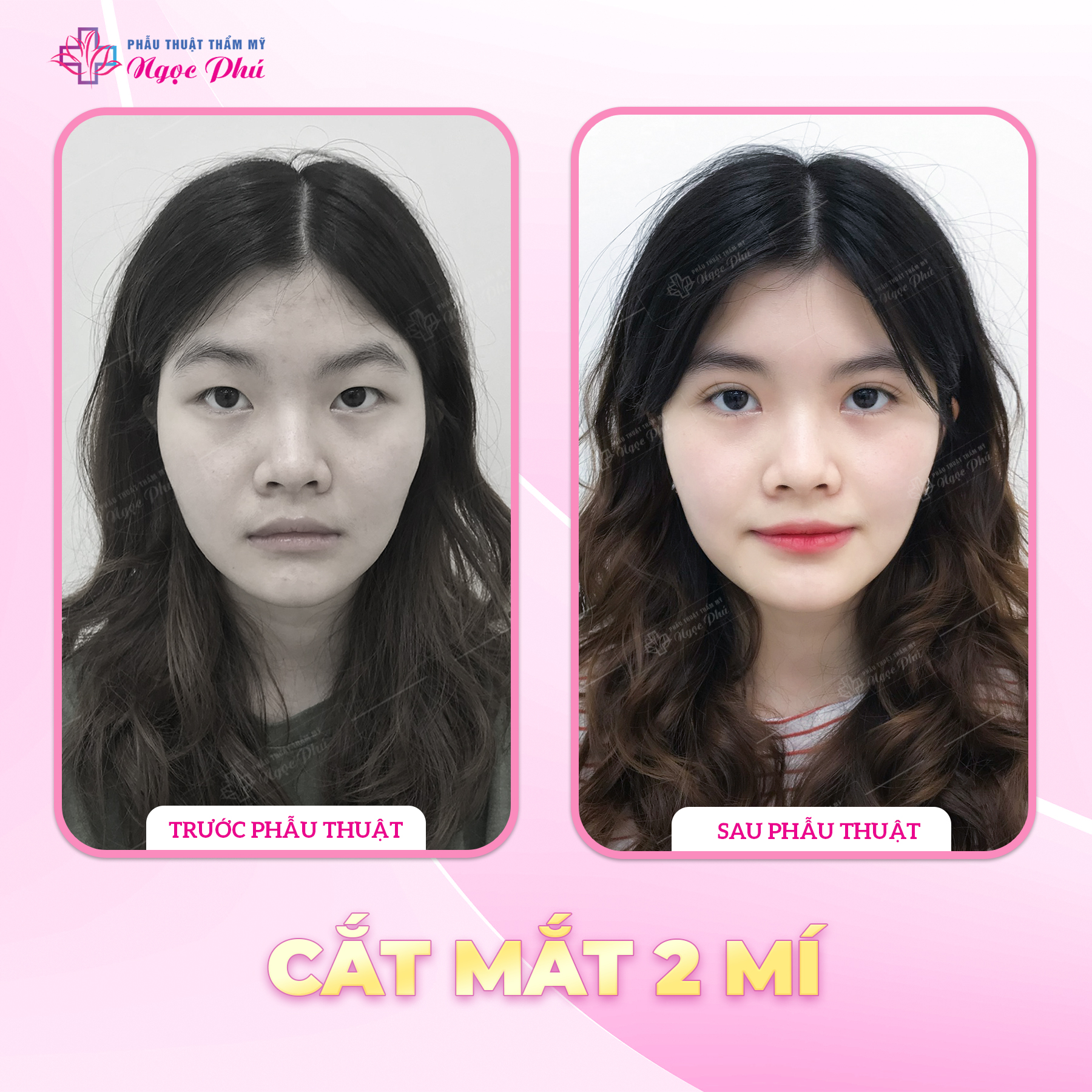 Cắt mí là một tiểu phẫu thẩm mỹ phổ biến, được thực hiện bằng cách tạo đường rạch mảnh trên da mí mắt, loại bỏ da thừa và mỡ bọng mắt, đồng thời tạo nếp mí mới.