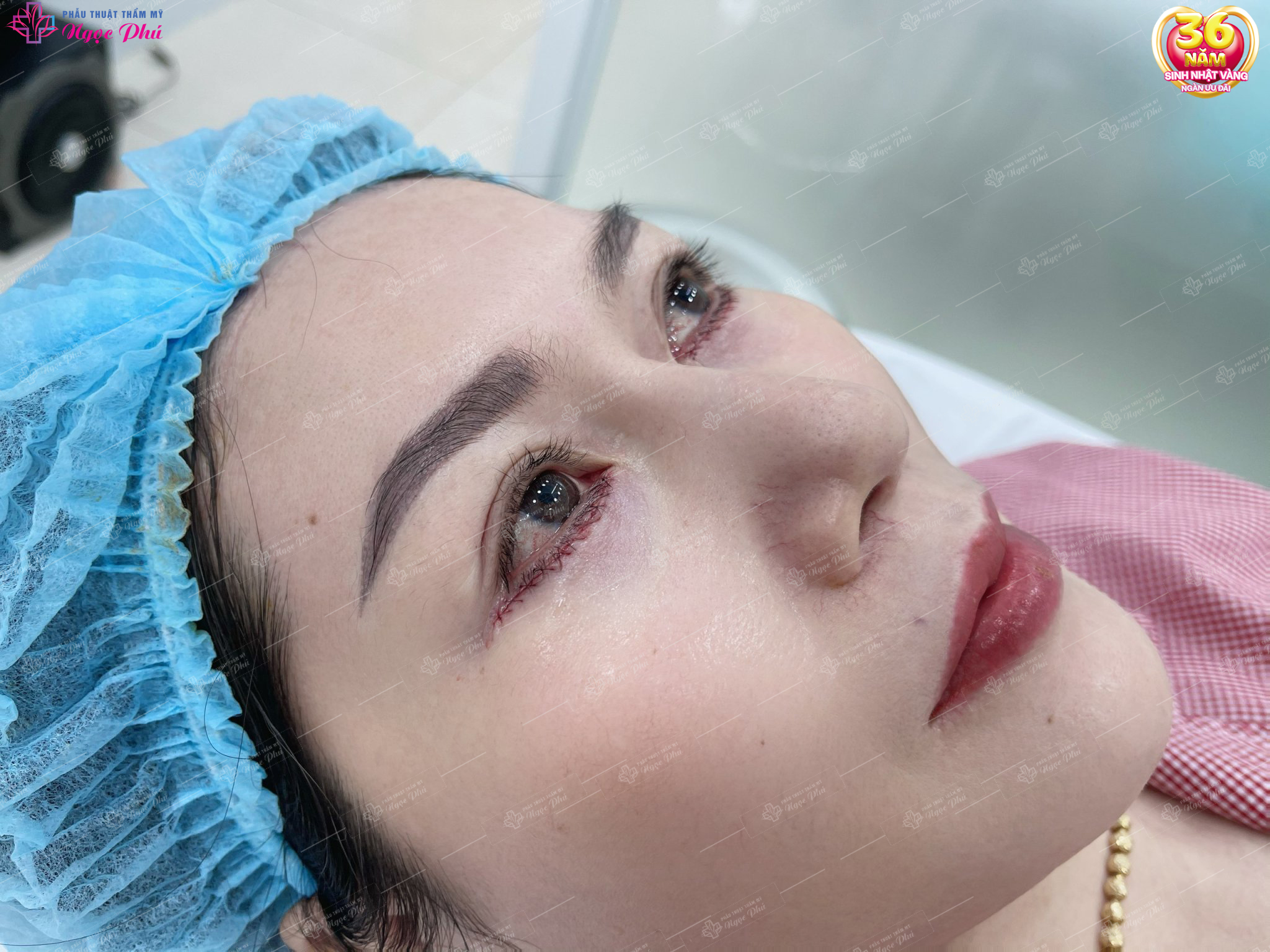 Cắt mí dưới có để lại sẹo không? Rất nhiều khách hàng thường rất lo lắng về vấn đề này.