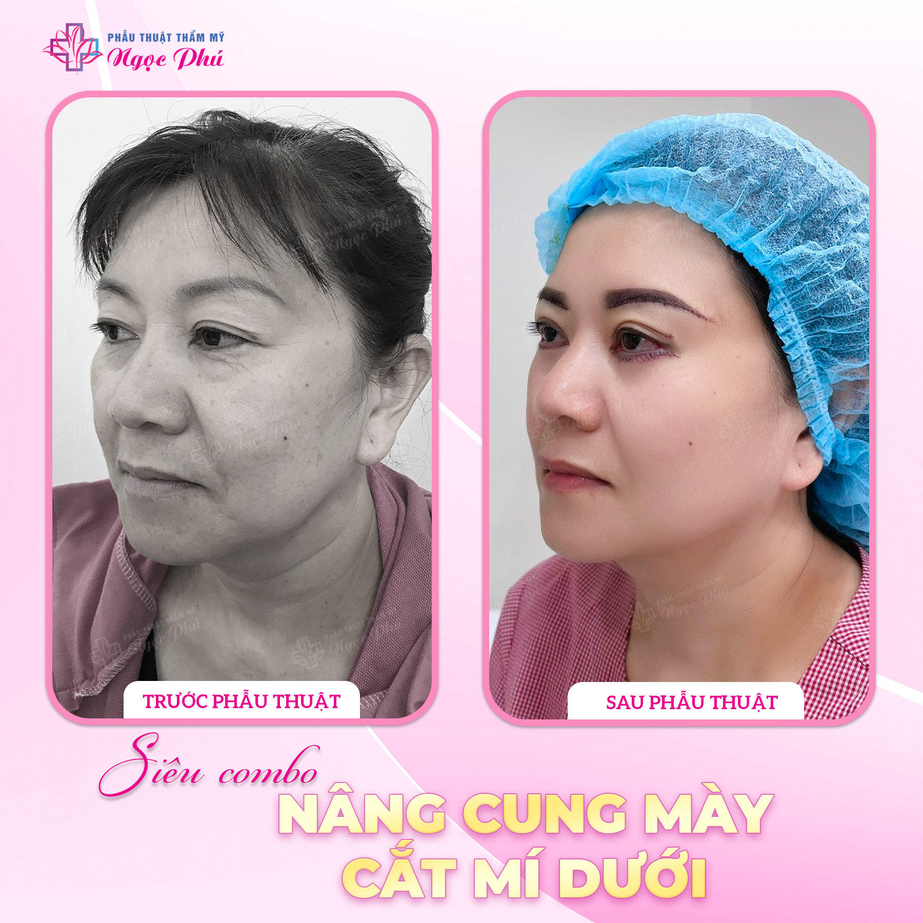 Cắt mí dưới có thể giúp cải thiện tình trạng da nhăn nheo và thâm quầng ở vùng mắt dưới.