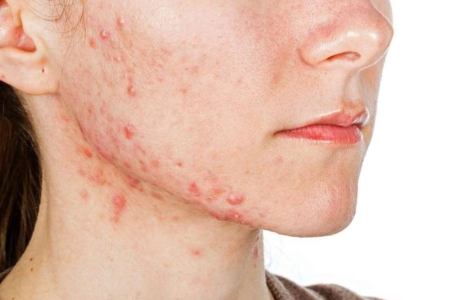 da mụn có tiêm Meso được không
