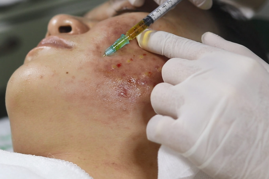 Da mụn có tiêm Meso được không? Câu trả lời là KHÔNG