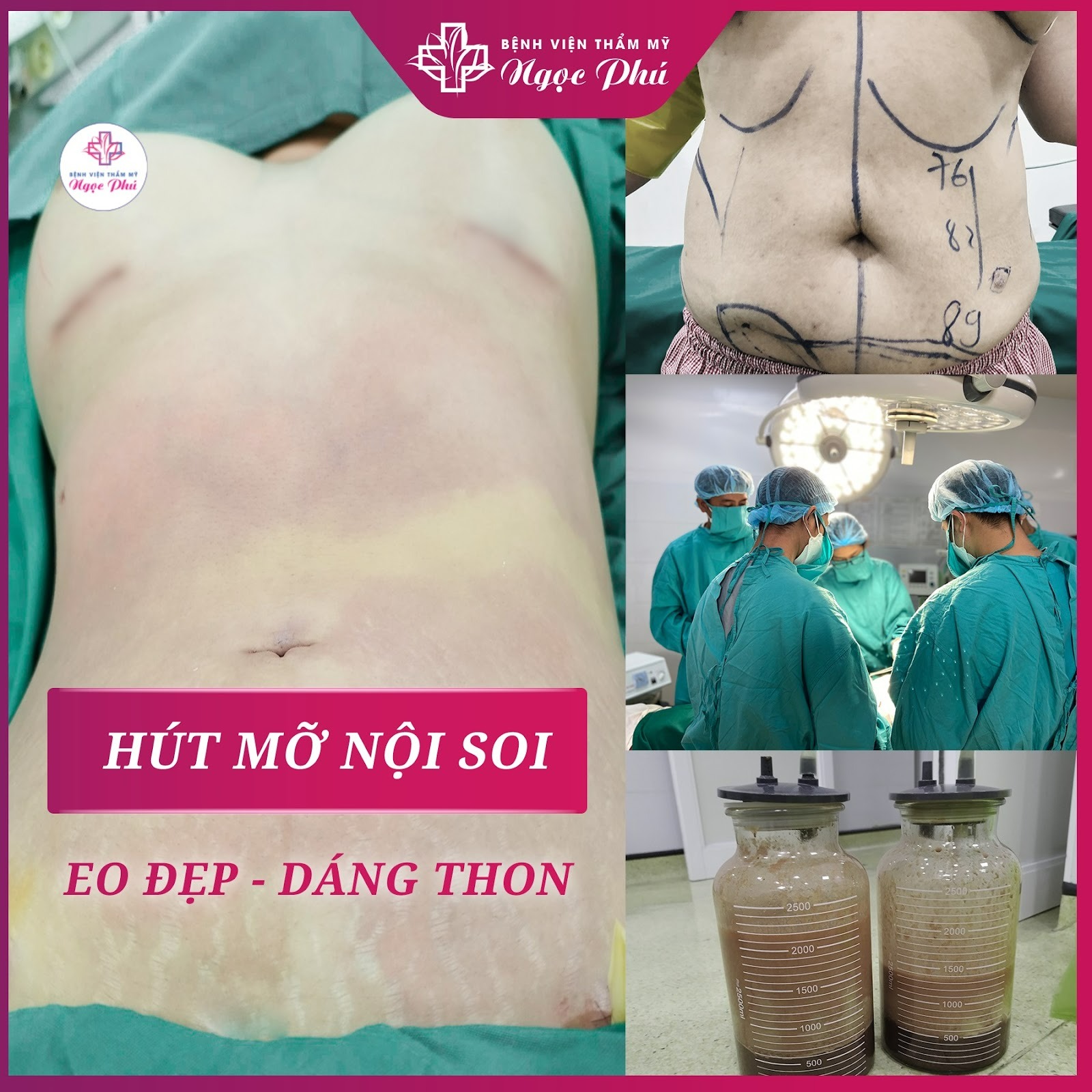 Hút mỡ bụng là phương pháp làm đẹp phổ biến, giúp loại bỏ mỡ thừa và tạo vóc dáng thon gọn hơn.