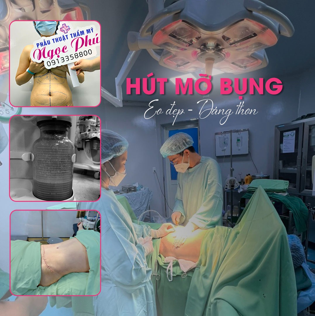 Hút mỡ bụng sau 1 tháng, việc chăm sóc đúng cách là rất quan trọng để đảm bảo quá trình lành thương diễn ra nhanh chóng và từ đó giúp khách hàng đạt được kết quả thẩm mỹ tốt nhất.