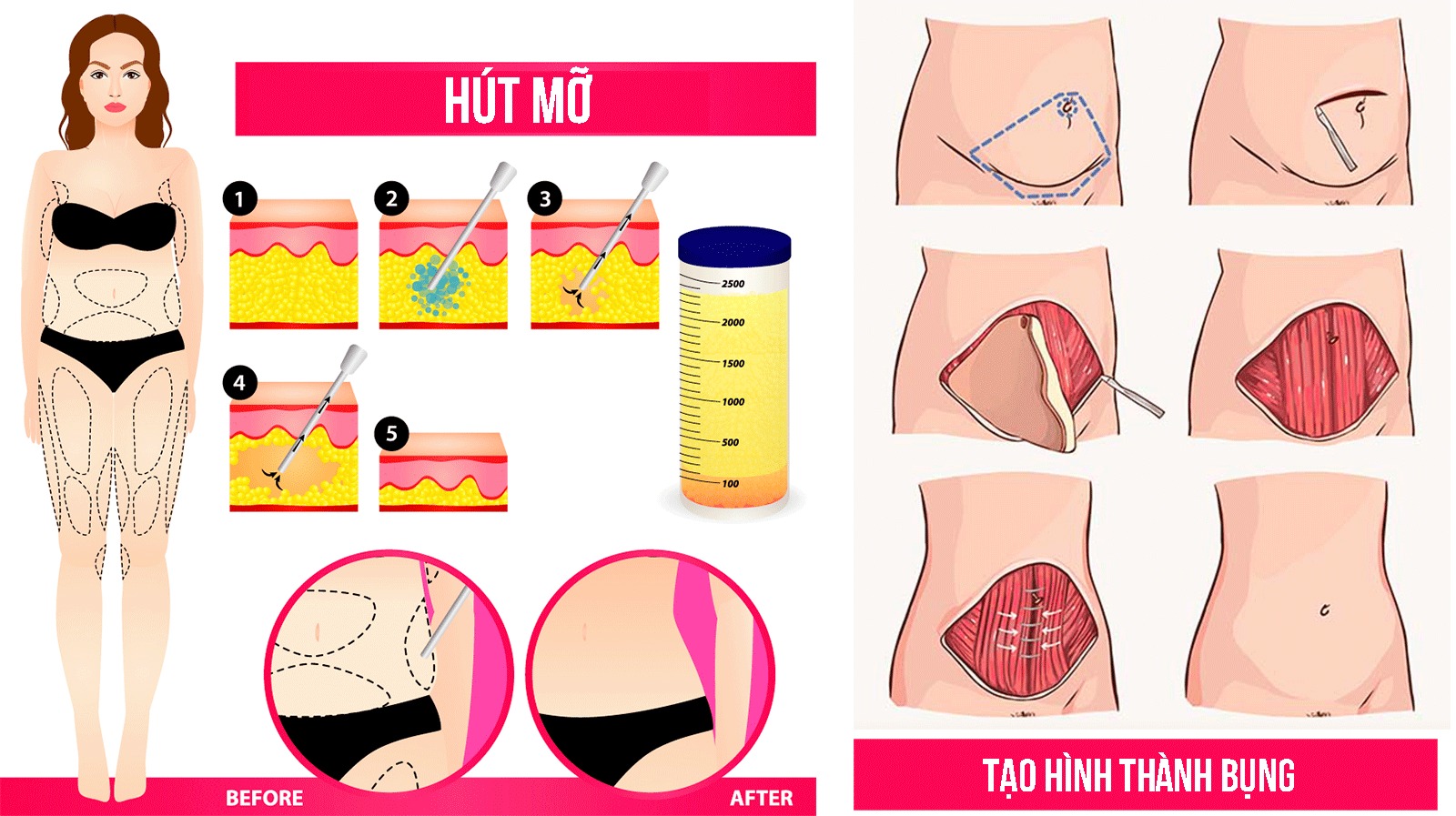 Nhiều mẹ bỉm sữa lo lắng về ngoại hình nhiều mỡ thừa sau sinh.