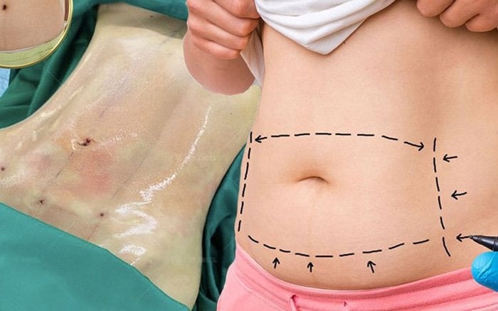 Hút mỡ căng da bụng là giải pháp vô cùng hiệu quả cho các mẹ bỉm sữa