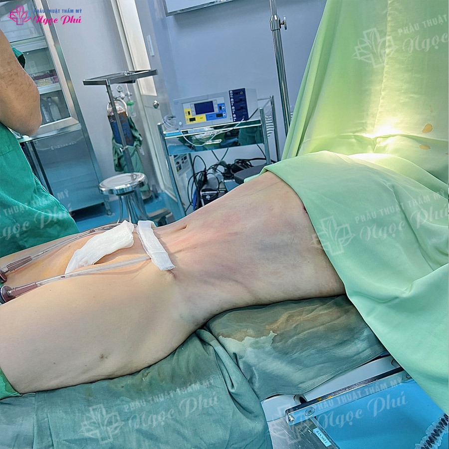 Hút mỡ căng da bụng là phương pháp thẩm mỹ tiên tiến, giúp loại bỏ mỡ thừa và làm săn chắc da bụng một cách hiệu quả.