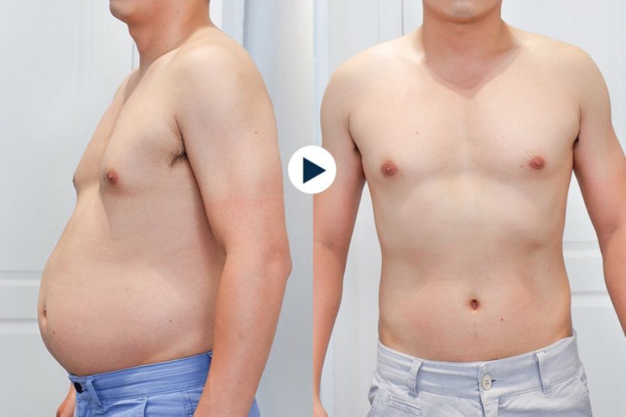 Hút Mỡ Bụng Giá Bao Nhiêu? Cách Săn Ưu Đãi Tại Thẩm Mỹ Ngọc Phú