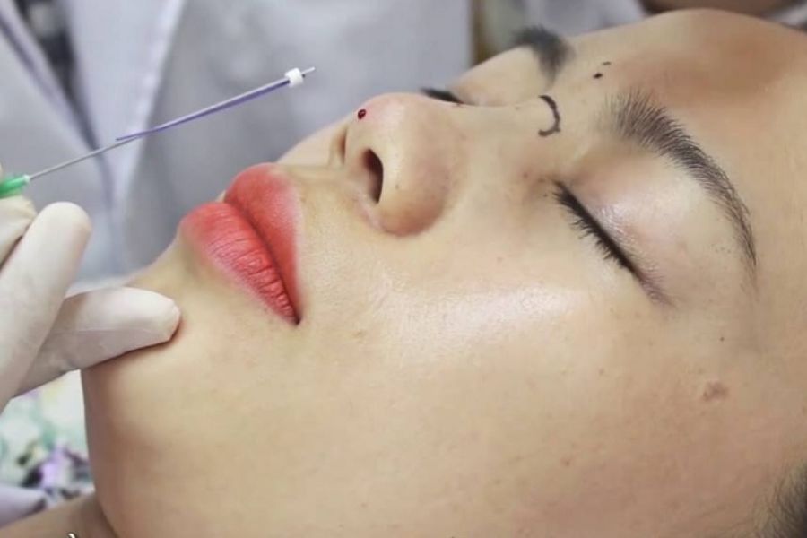 Nâng mũi chỉ có tự tiêu không? Câu hỏi mang nhiều sự e dè của khách hàng