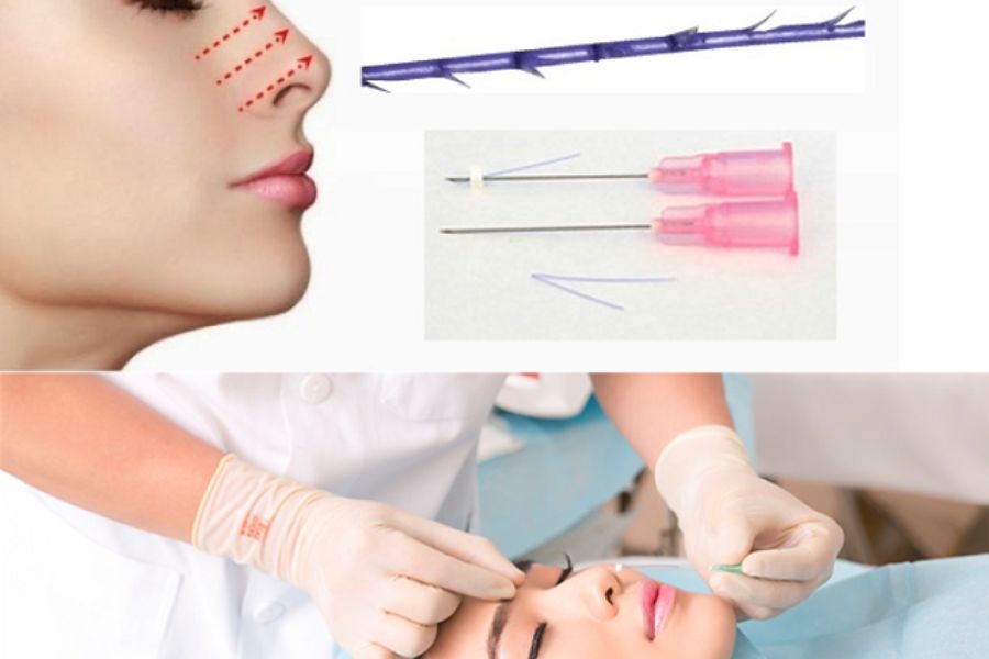 Nâng mũi chỉ có tự tiêu không? Có, nhưng sẽ không bền lâu như phương pháp phẫu thuật