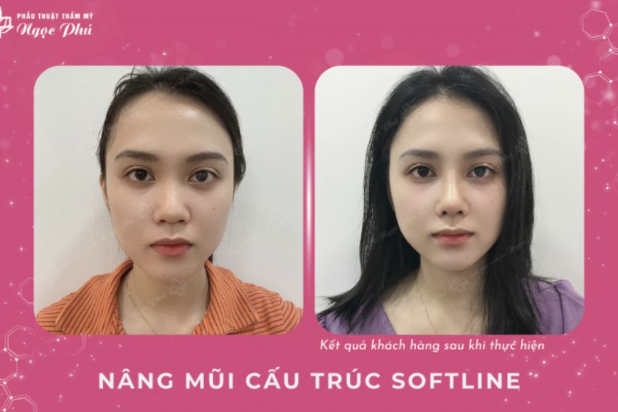 Nâng mũi chỉ có tự tiêu không? Có, nhưng sẽ không bền lâu như phương pháp phẫu thuật