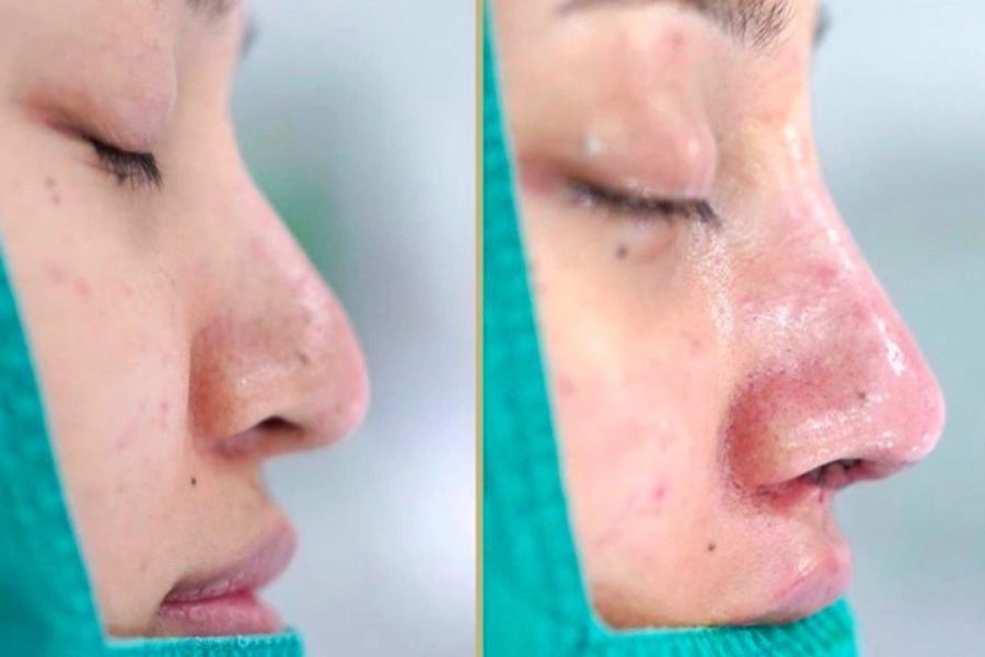 Nâng mũi đầu mũi bị to là hiện tượng thường gặp và có thể giảm dần rồi hoàn toàn biến mất sau một thời gian.