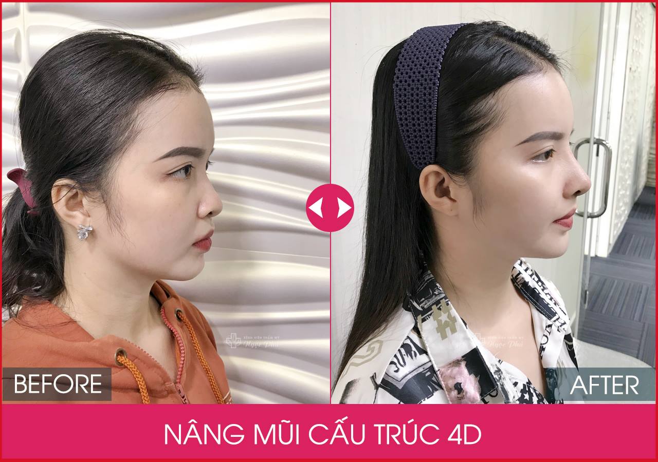  phương pháp nâng mũi đang là sự lựa chọn phổ biến để cải thiện khuyết điểm và tăng cường sự tự tin khi giao tiếp.